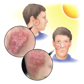клинические симптомы и локализация солнечного дерматита